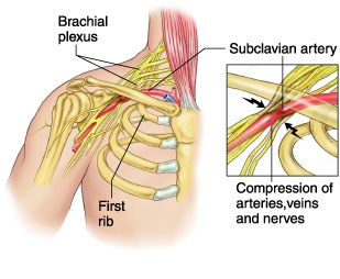 Illustratie van het thoracic outlet syndroom
